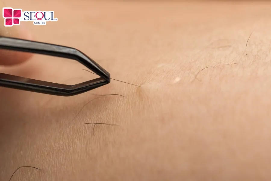 Chỉ nên nhổ mỗi lần một sợi và nhổ theo chiều lông mọc để tránh gây đau và viêm da