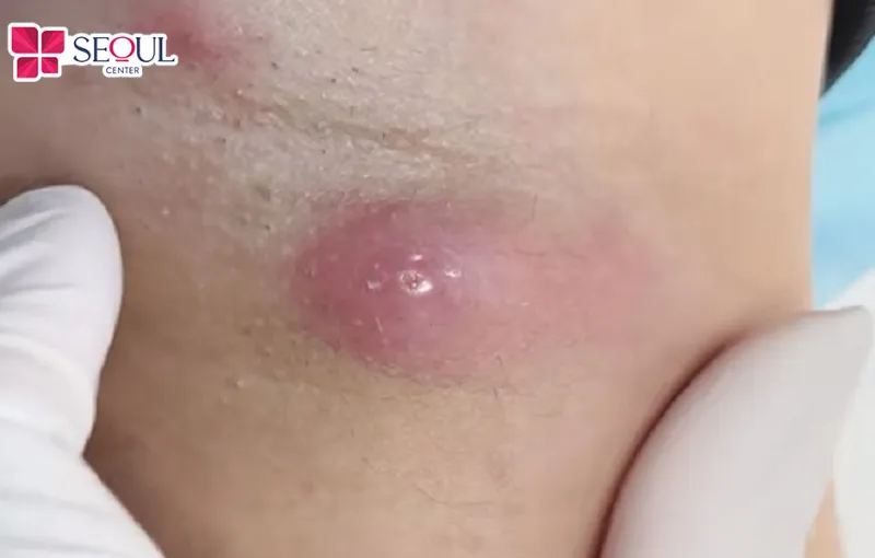 Nếu da vùng nách có mụn viêm mủ thì không nên nhổ lông nách để tránh viêm nặng hơn