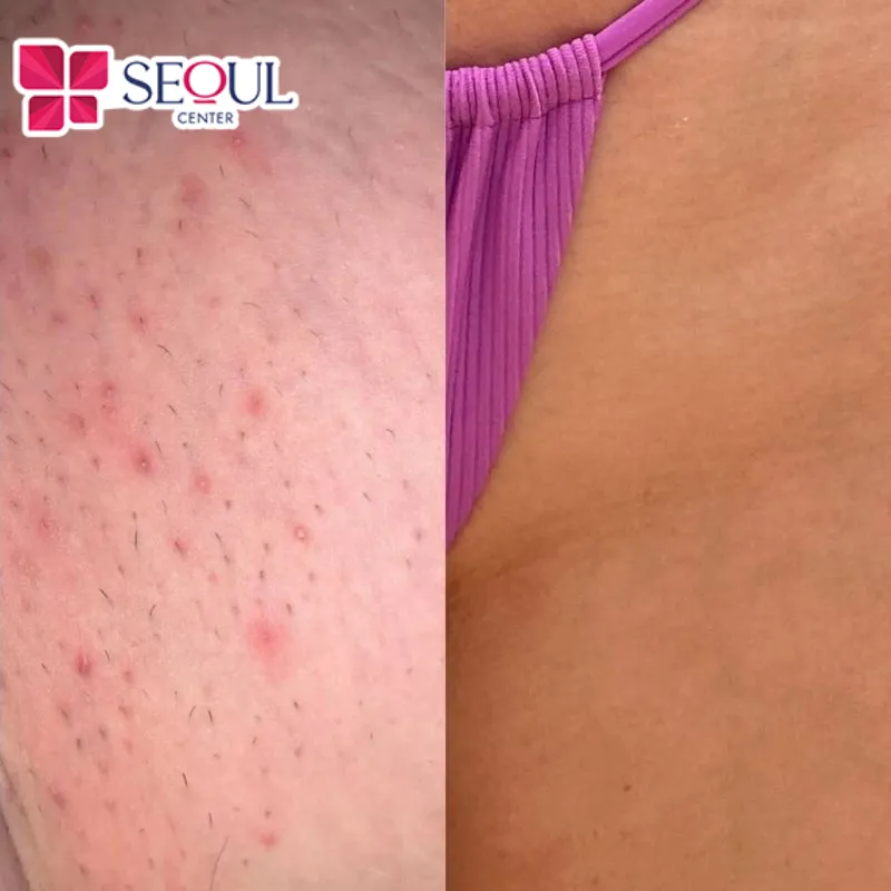 Nếu cạo quá sát sẽ khiến da nổi mẩn đỏ li ti, kích ứng ngoài da