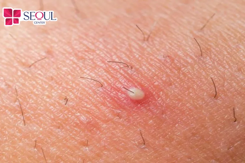 Nếu thực hiện không đúng cách có thể khiến vùng da xuất hiện lông mọc ngược