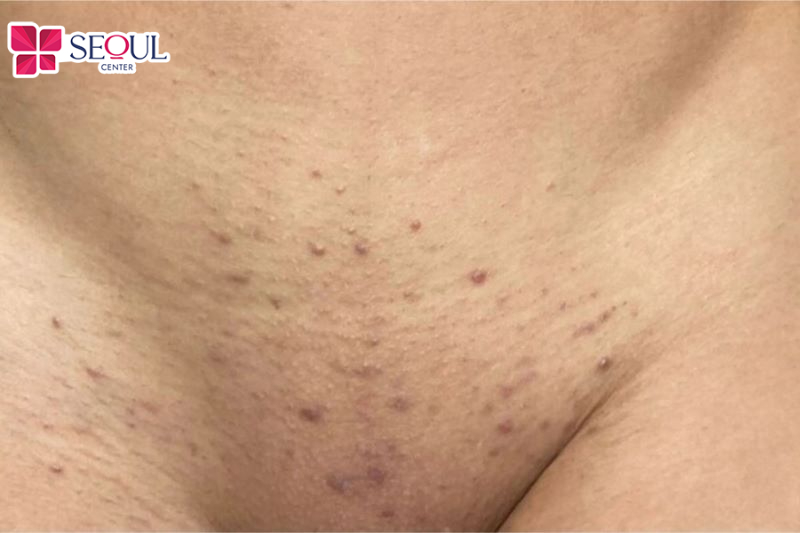 Nếu wax lông sai cách có thể khiến lông mọc ngược, da trở nên thâm sạm hoặc dễ bị viêm nang lông