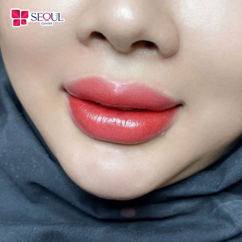 Phương pháp hút mực xăm môi là giải pháp phổ biến hiện nay được nhiều người lựa chọn