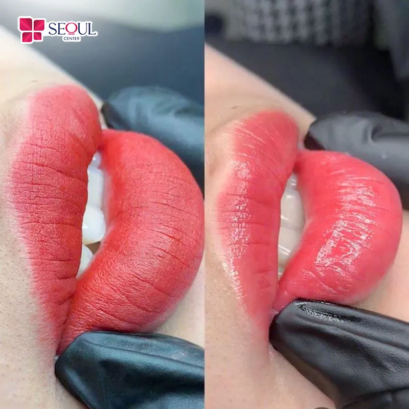 Màu môi đẹp tự nhiên của khách hàng được lộ diện sau khi đến Seoul Center hút mực xăm