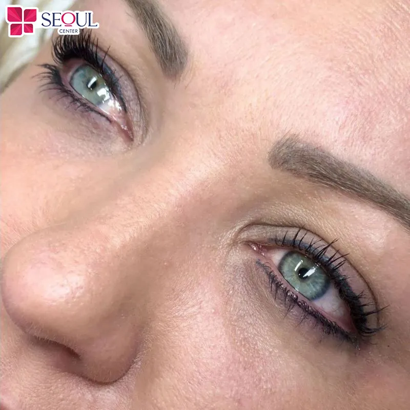 Kỹ thuật kết hợp phun cả mí dưới và mí trên giúp cải thiện vùng mắt, không làm đau nhức