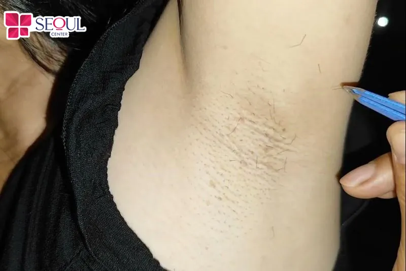 Tránh cạo nhổ lông sai cách khiến vùng da nách trở nên sần sùi, thậm chí có thể bị viêm nhiễm