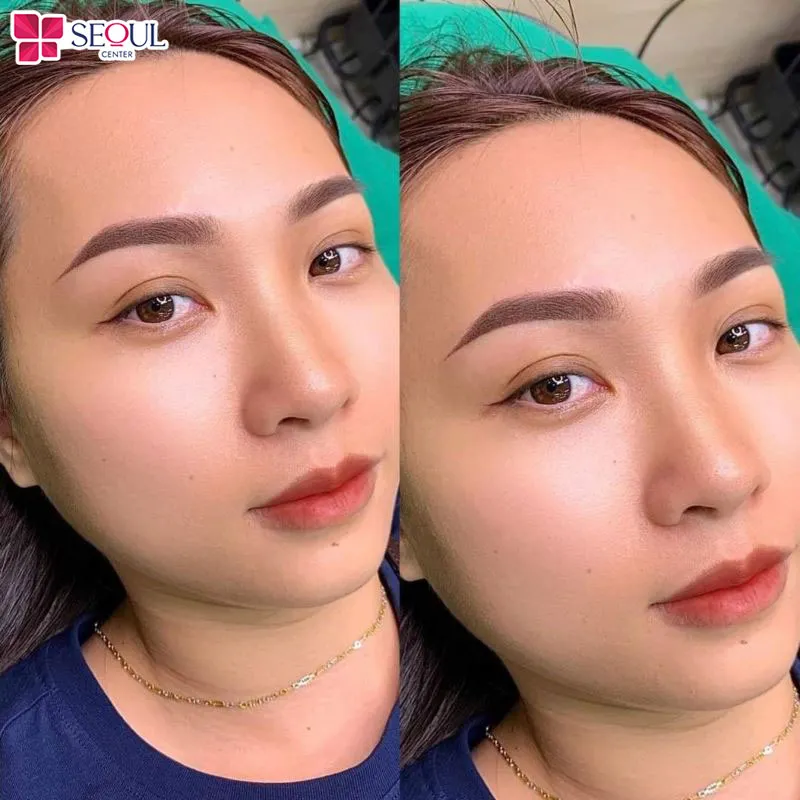 Cả hai kỹ thuật đều giúp gương mặt trông tươi tắn, hài hòa hơn