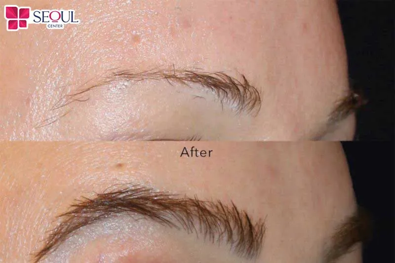 Nhược điểm cấy lông mày còn tiềm ẩn nhiều rủi ro nếu thực hiện không đúng cách