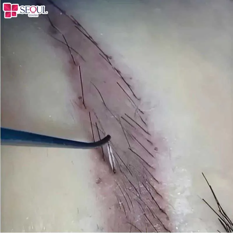 Nang tóc sẽ được cấy vào vùng chân mày nên cần thời gian để bám và thích nghi với các tế bào trong cơ thể
