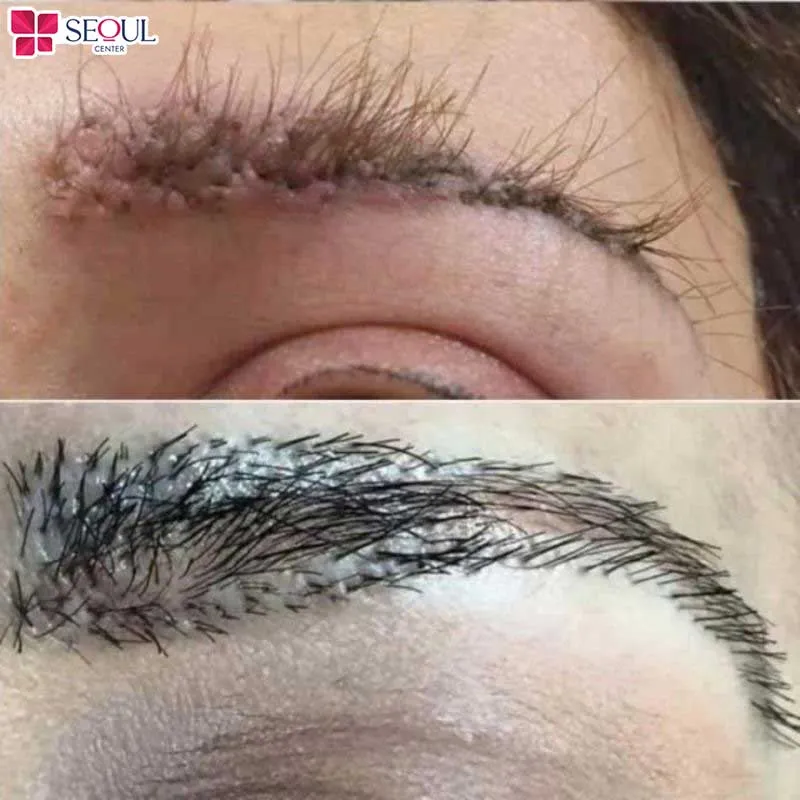 Dáng mày không đẹp như mong đợi cũng là một trong những nhược điểm cấy lông mày