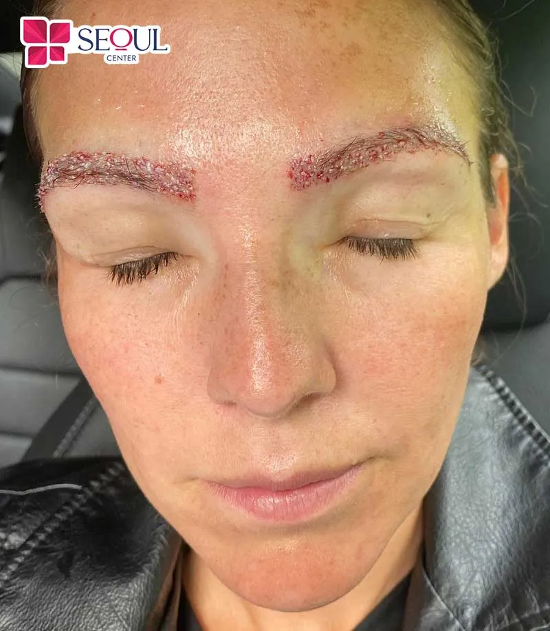 Nếu thực hiện cấy lông mày tại cơ sở kém chất lượng sẽ ảnh hưởng tới thẩm mỹ, sức khỏe làn da