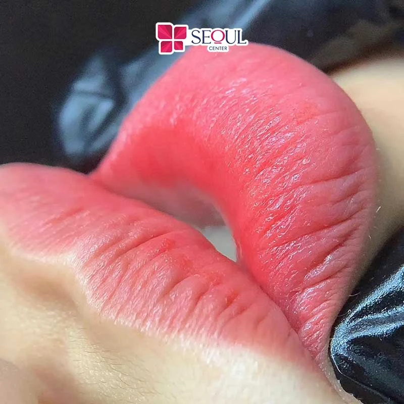 Phun môi công nghệ softlips để tạo hình dáng môi cân đối, hài hòa