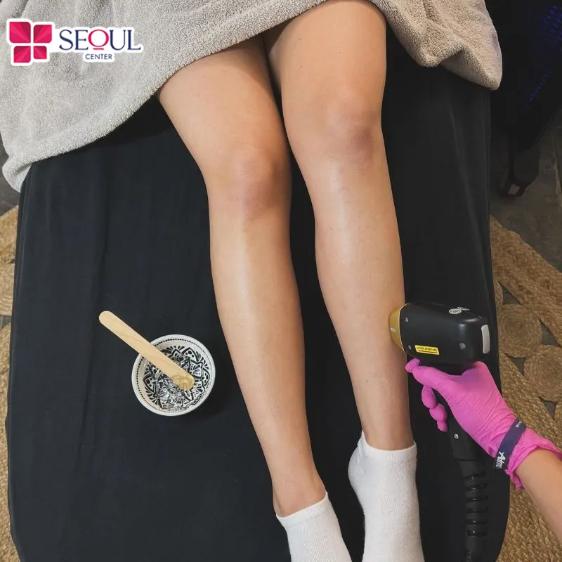 Số buổi triệt lông sẽ phụ thuộc vào từng vùng da trên cơ thể như tay chân, nách, vùng bikini