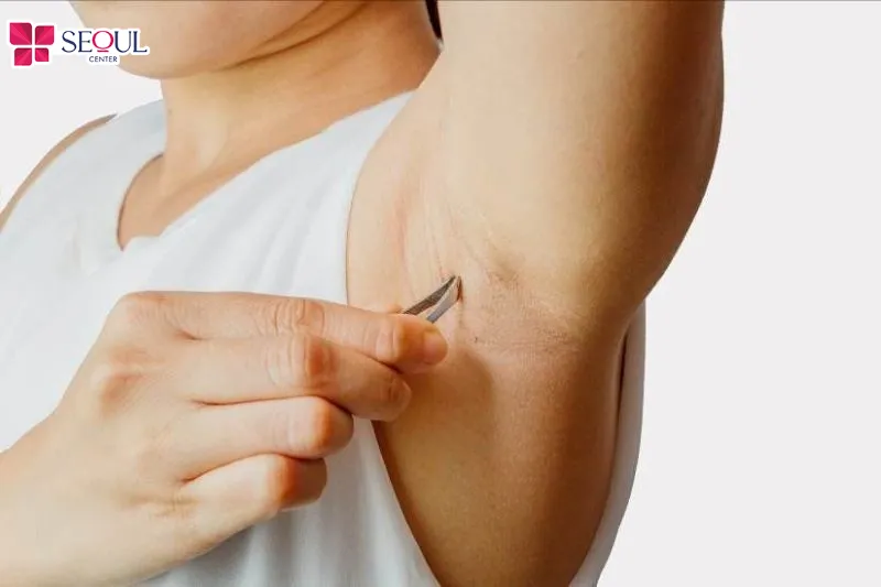 Tuyệt đối không được cạo, nhổ hay wax lông trước buổi triệt