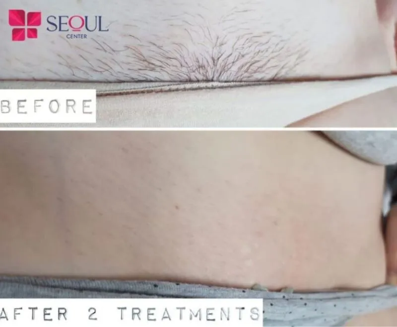 Khách hàng sau khi triệt lông tại Thẩm mỹ viện Seoul Center