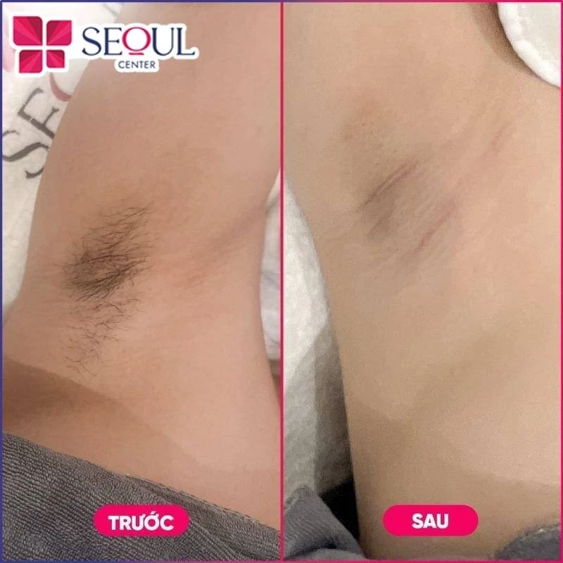 Làn da của khách hàng sau khi thực hiện triệt lông bằng công nghệ hiện đại tại Seoul Center
