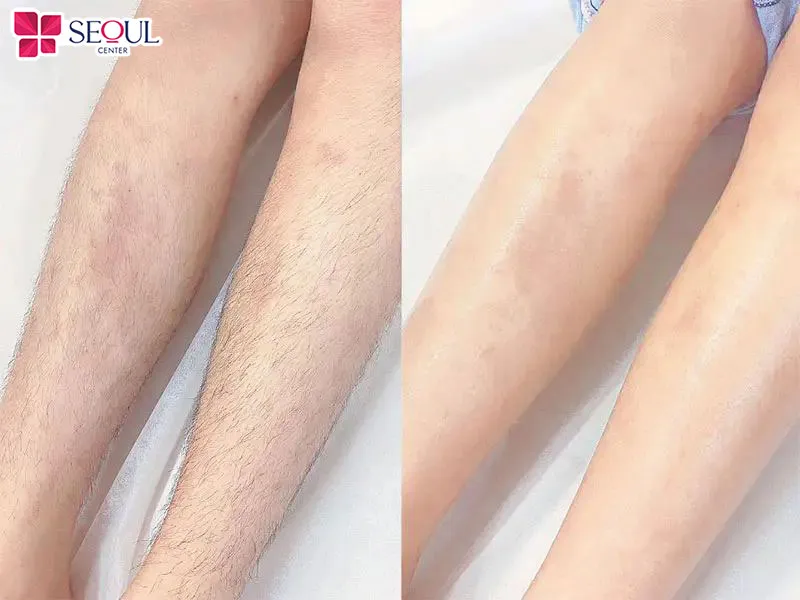 Triệt lông chân tại nhà mang lại nhiều lợi ích nổi bật