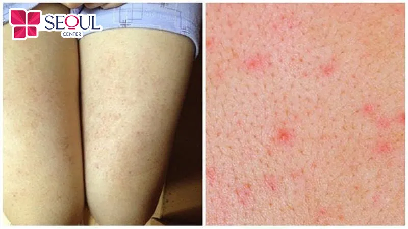 Không vệ sinh dao cạo trước khi sử dụng có thể dẫn đến tình trạng viêm nang lông