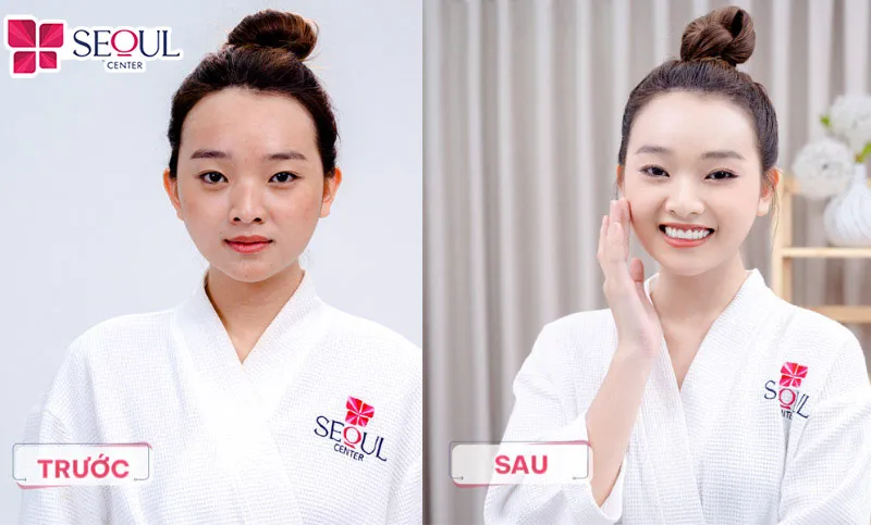 Liệu trình chăm sóc da không kim Infusion sở hữu nhiều ưu điểm vượt trội