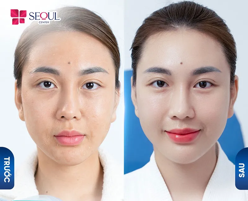 Với cơ chế của liệu trình chăm sóc da trẻ hóa Infusion giúp mang lại nhiều lợi ích cho da