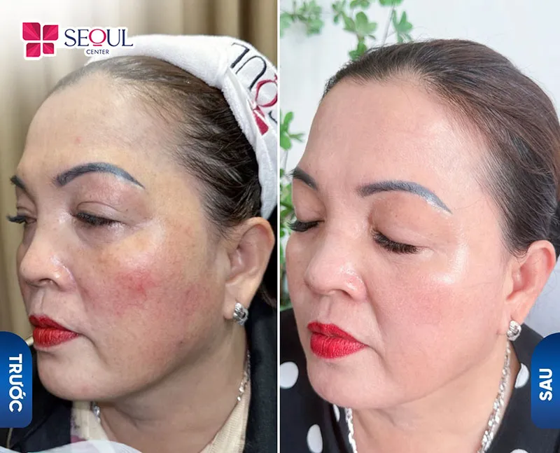 Dịch vụ chăm sóc da trẻ hóa Infusion có kết hợp đa công nghệ cùng hoạt chất giúp da căng bóng, tươi trẻ, mịn màng