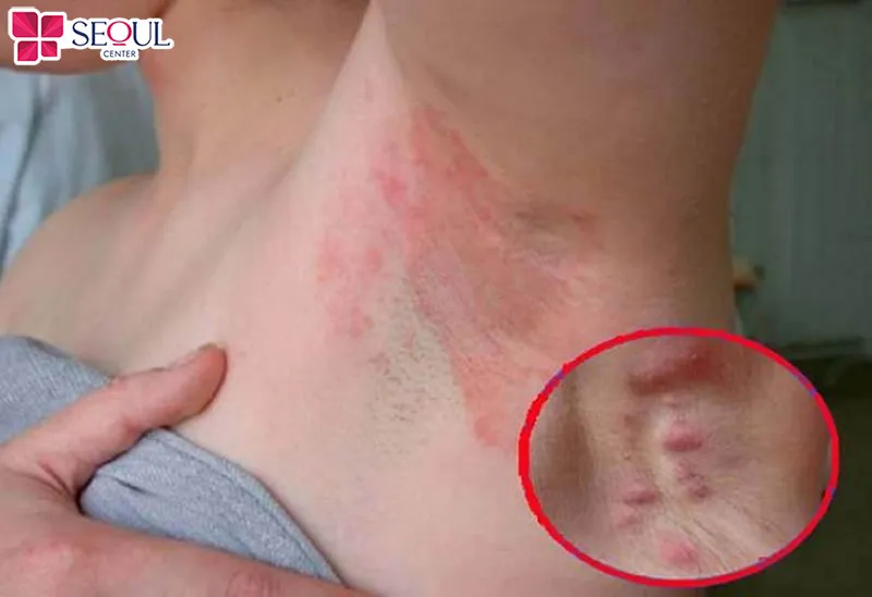 Da bị kích ứng, viêm da sau khi cạo lông không đúng cách, sử dụng dao cạo không sạch, không vô trùng