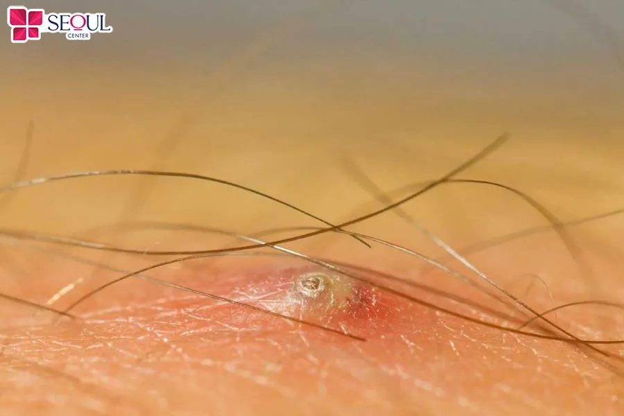 Lông mọc ngược là một trong những ảnh hưởng thường gặp khi cạo lông nách không cùng hướng lông mọc