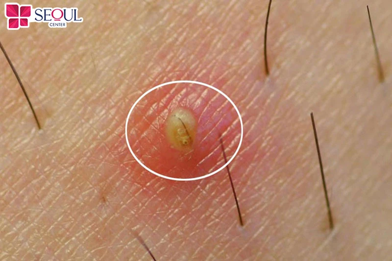 Lông vùng kín mọc ngược có thể gây kích ứng, viêm nhiễm da