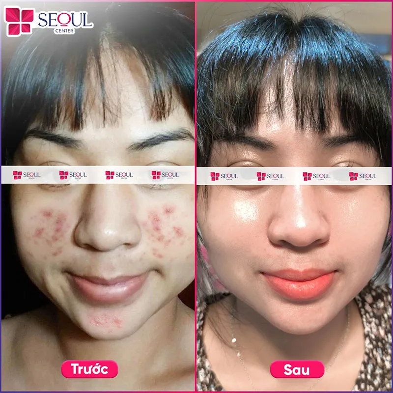 Cô gái tạm biệt mụn thâm đón Tết tự tin sau liệu trình điều trị DermaPerfecta tại Seoul Center