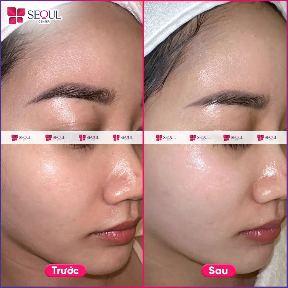 Da nâng tông, đều màu, sáng khỏe hơn sau liệu trình Chăm sóc da Cao Cấp Infusion