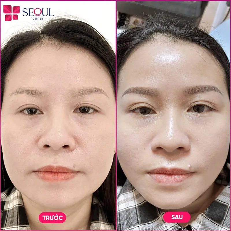 Khách hàng trước và sau khi thực hiện dịch vụ Chăm sóc da Trẻ Hoá Infusion