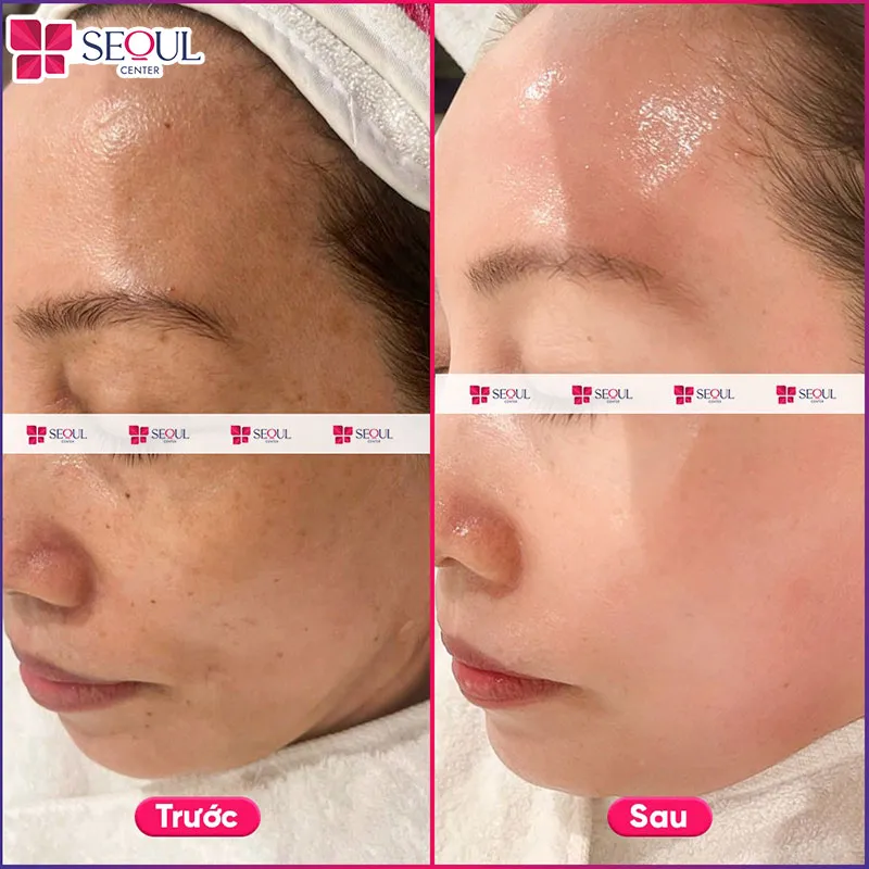 Da giảm nám, hồng hào, giảm xỉn màu, bề mặt mượt hơn sau liệu trình AI Renew - Mela Sáng Da