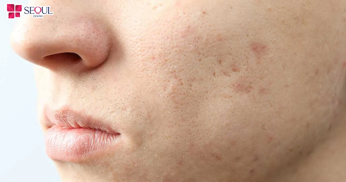 Tái tạo mô ECM là liệu pháp trị sẹo, phục hồi da bằng cách kết hợp công nghệ ECM cùng kỹ thuật vi điểm đa tầng