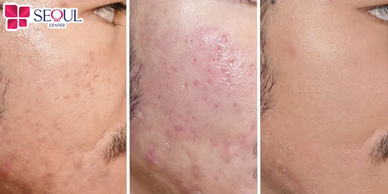 Tái tạo mô ECM giúp xóa sẹo, da mềm mịn, tươi tắn và sáng hơn