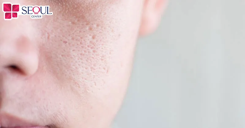 Những ai bị sẹo nhẹ, lỗ chân lông to, muốn tái tạo mô da thay đổi nền da mịn màng hơn thì có thể tham khảo sử dụng dịch vụ tái tạo mô ECM