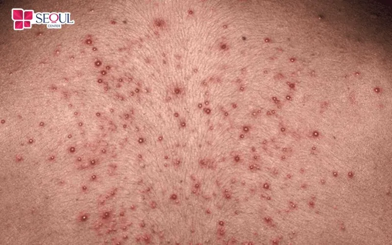 Triệt lông vùng kín sai cách, khâu vệ sinh không đảm bảo, dụng cụ không vô trùng có thể gây ra tình trạng viêm nhiễm phụ khoa