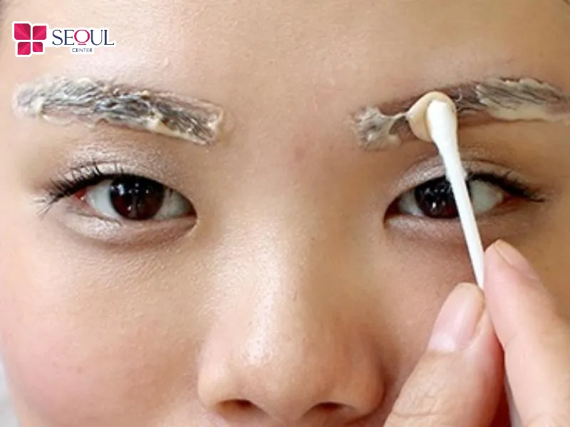 Phương pháp này sử dụng axit có tính ăn mòn mạnh như axit trichloroacetic để loại bỏ lớp mực xăm dưới da