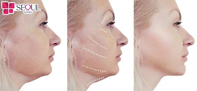 Căng da mặt mini là kỹ thuật kéo căng da các mô bị chùng nhão và cắt bỏ phần da dư thừa, lấy lại diện mạo trẻ trung cho khách hàng