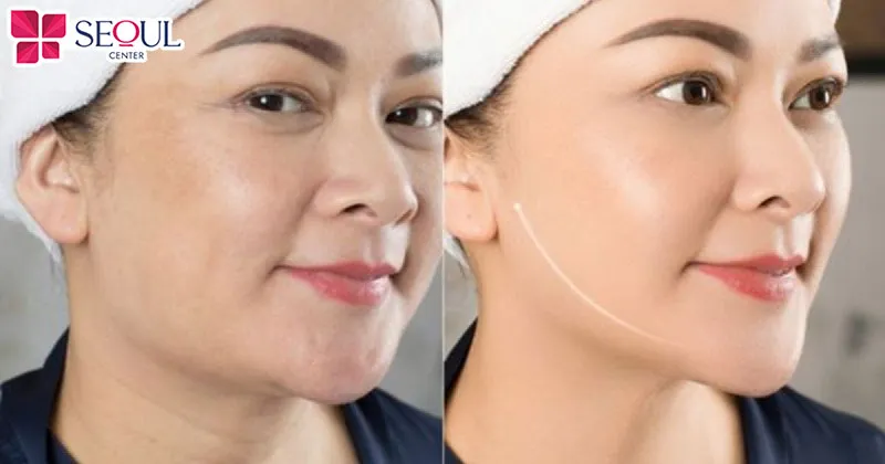 Căng da mặt mini giúp diện mạo khách hàng trẻ trung hơn nhiều tuổi