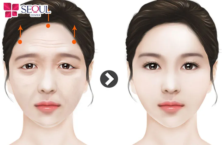 Căng da trán là phương pháp kéo căng da vùng trán khắc phục tình trạng nếp nhăn, da chùng nhão ở trán