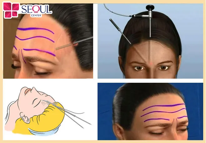 Căng da trán nội soi duy trì hiệu quả lâu dài hơn nhưng kỹ thuật thực hiện khá phức tạp