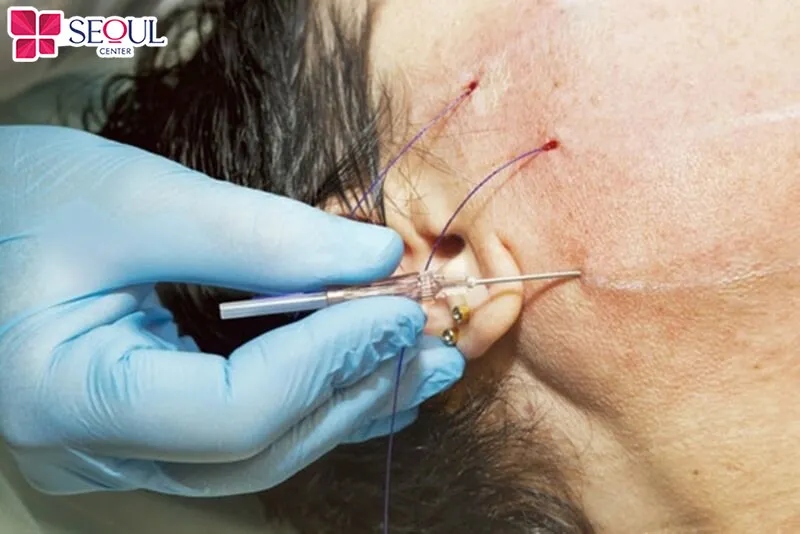 Kỹ thuật căng da trán bằng chỉ chỉ duy trì khoảng 2-3 năm