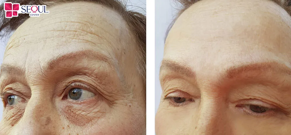 Căng da trán không chỉ giúp da vùng trán trẻ hóa mà còn mịn màng