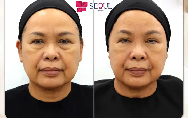 Gương mặt trở nên trẻ trung, tươi tắn hơn sau khi thực hiện cắt mí dưới Perfect tại Seoul Center