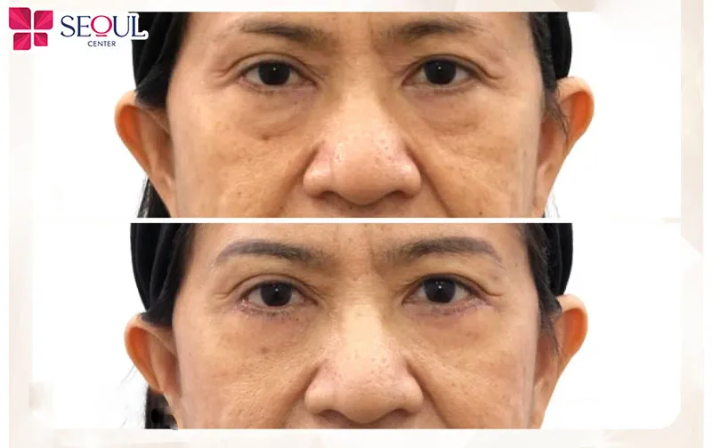 Cắt mí dưới Perfect tại Seoul Center giúp trẻ hóa vùng da dưới mắt