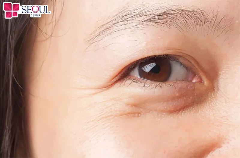 Quy trình cắt mí dưới Perfect tại Seoul Center được tiến hành bởi bác sĩ có chuyên môn cao