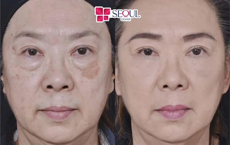 Khách hàng sau khi thực hiện cắt mí dưới Perfect tại Seoul Center