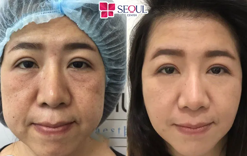 Kết quả cắt mí dưới Perfect tại Seoul Center mang đến vẻ đẹp tươi trẻ