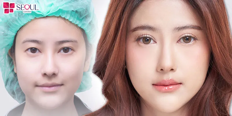 Cắt mí Perfect là phương pháp khắc phục mắt một mí, mí lót bằng cách kết hợp rạch mảnh siêu nhỏ và công nghệ khâu hiện đại