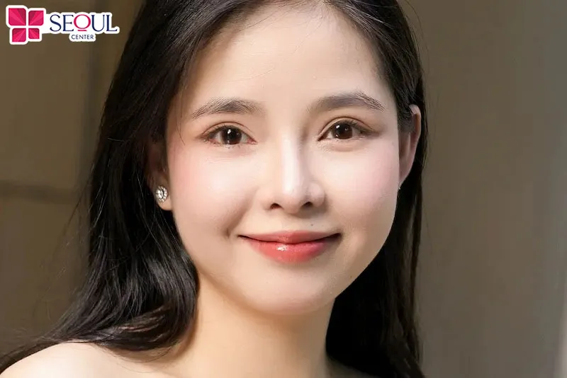 Cắt mí Perfect là kỹ thuật tạo nếp mí đẹp, sắc nét nhất