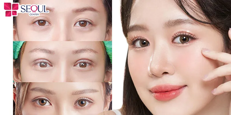 Cắt mí giúp đôi mắt trở nên tươi sáng, rạng rỡ, to tròn, cuốn hút, diện mạo trẻ trung hơn